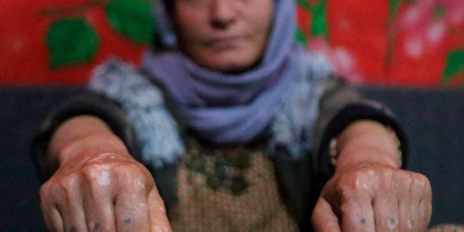 Baseh Hammo är en av många yazidiska kvinnor som utsatts för IS våld. Skadorna på hennes händer fick hon när en IS-anhängare tvingade henne att trycka knogarna mot kokhet asfalt.